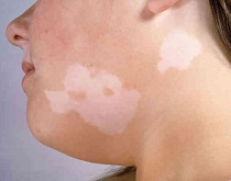 Vitiligo Signs And Symptoms
