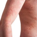 psoriasis causes