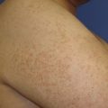 Keratosis Pilaris causes