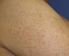 Keratosis Pilaris causes